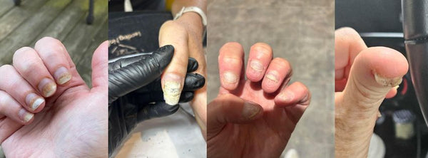 Exploderen de allergieën in de nagelsector? Zitten we op een tikkende tijdbom?